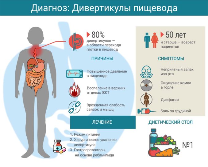 дивертикул пищевода