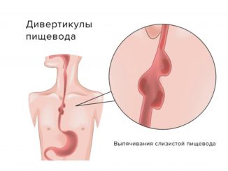 дивертикул пищевода